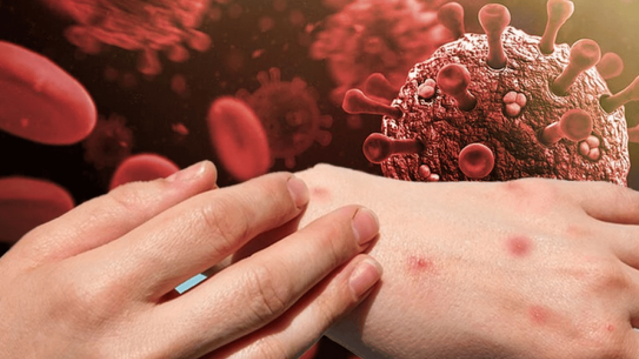 Foto - Neler oluyor böyle? M Çiçeği Virüsü Yayılıyor: Tüm dünya şaşkın bu işe…