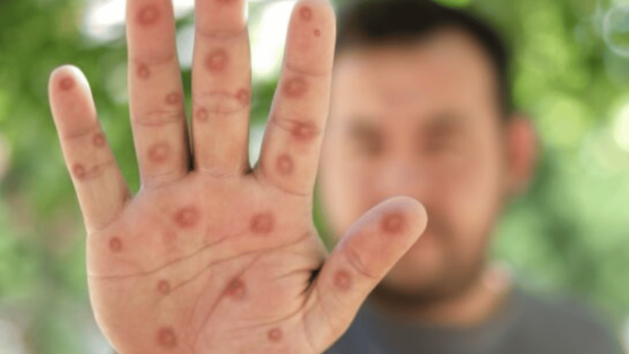 Neler oluyor böyle? M Çiçeği Virüsü Yayılıyor: Tüm dünya şaşkın bu işe…