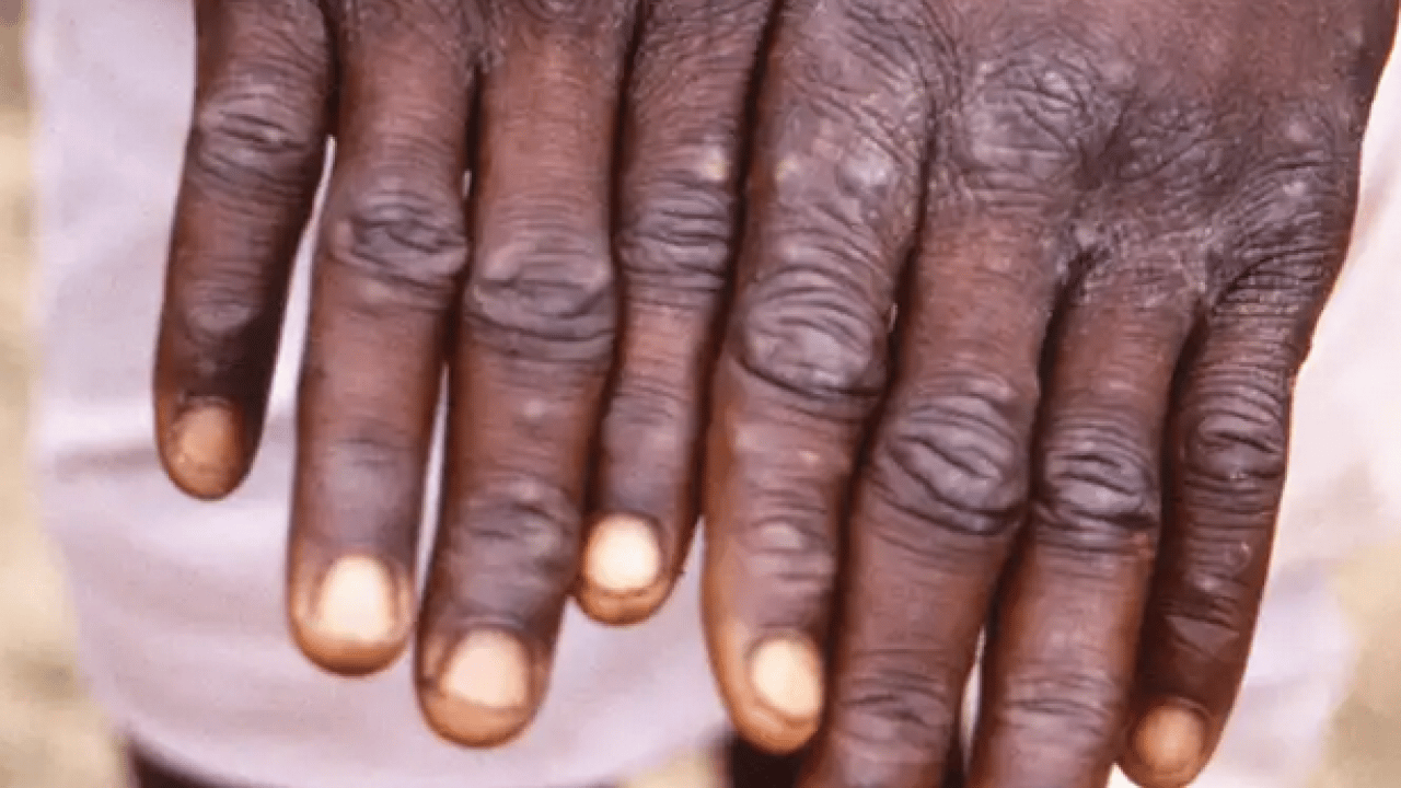 Foto - Neler oluyor böyle? M Çiçeği Virüsü Yayılıyor: Tüm dünya şaşkın bu işe…