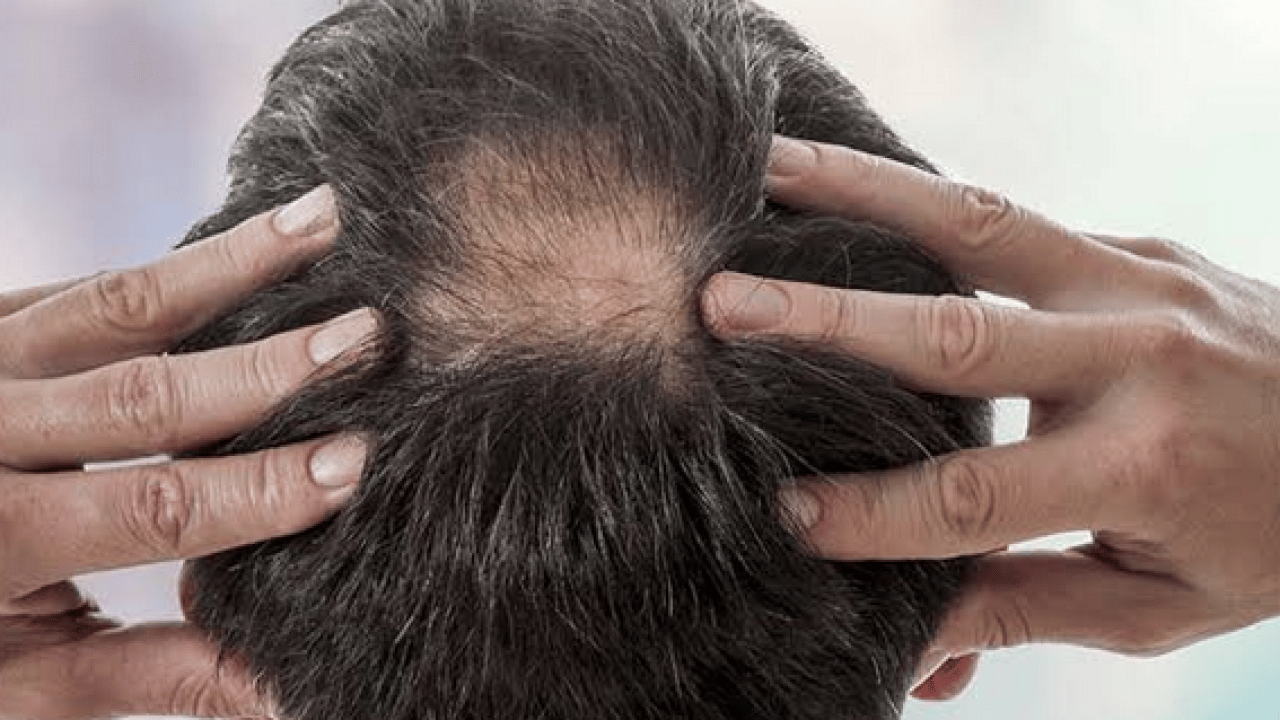 Foto - O yöntem ortaya çıktı ve şiddetle önerdi... Prof. Dr. İbrahim Saraçoğlu'ndan dökülen saçlar için etkili formül...