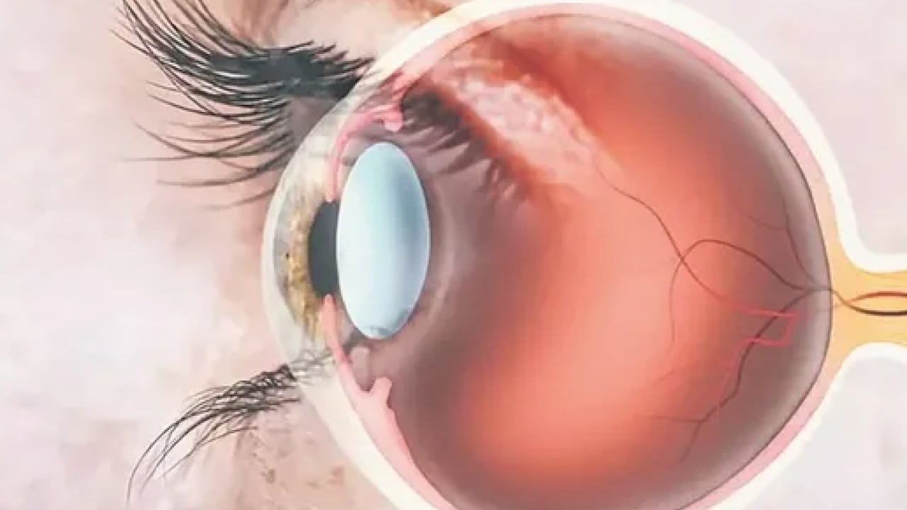 Foto - Oküler Onkoloji uzmanı tavsiye ediyor: Gözde sessizce büyüyebiliyor!