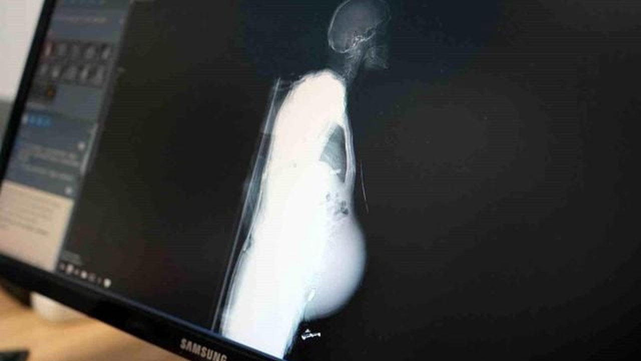 Foto - Onlar da ilk defa karşılaştılar! Halsizlik şikayetiyle gitti, karnından çıkan şey doktorları bile şoke etti