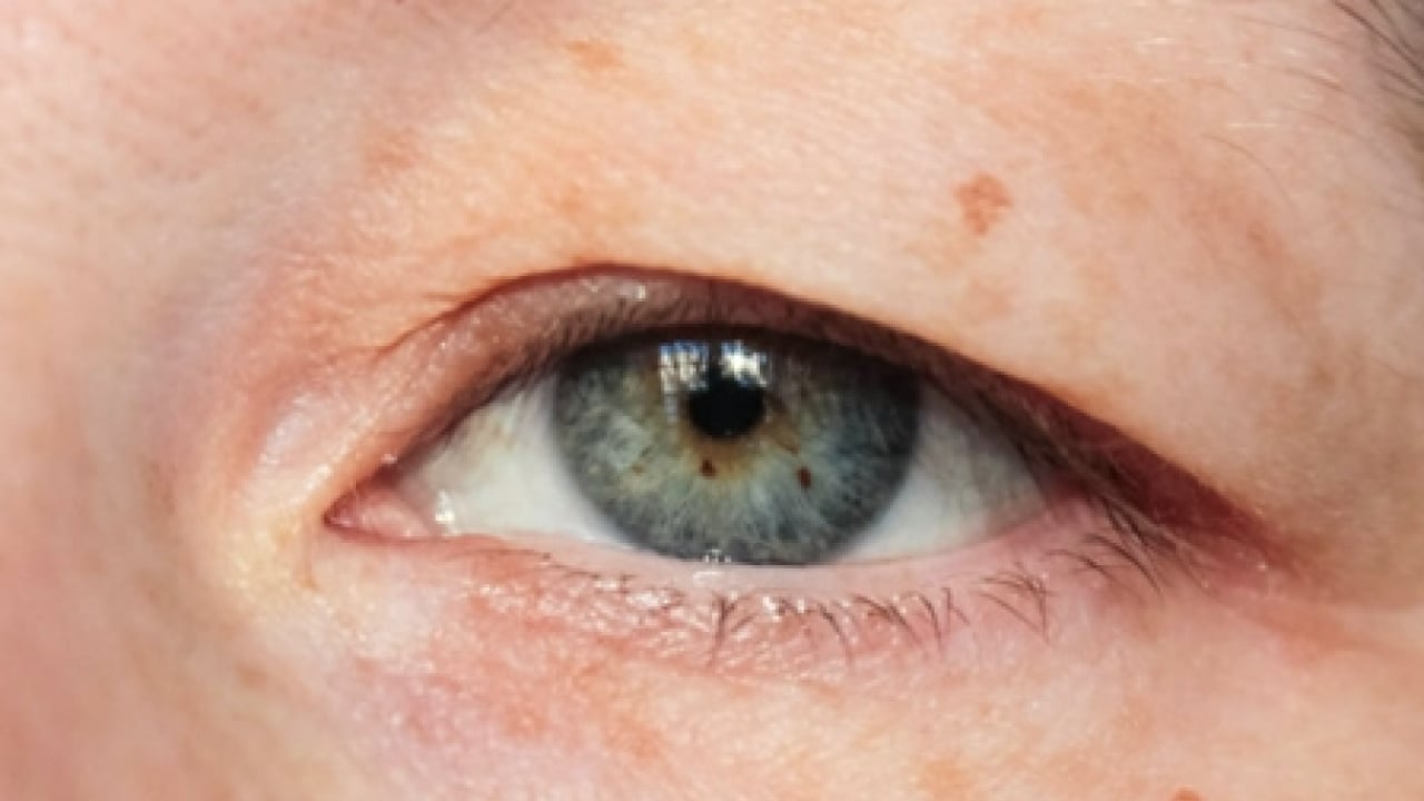 Foto - Op. Dr. açıkladı: Çekici görünen bakışın altında hastalık olabilir