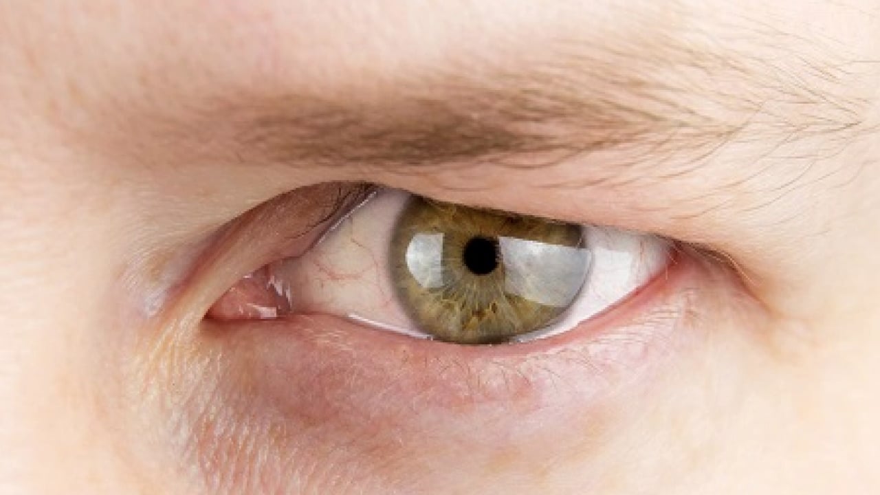 Foto - Op. Dr. açıkladı: Çekici görünen bakışın altında hastalık olabilir