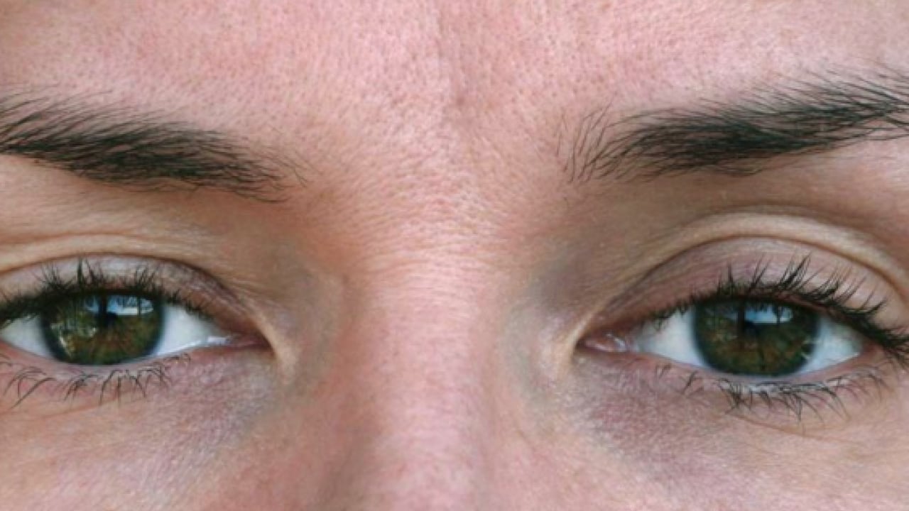 Foto - Op. Dr. açıkladı: Çekici görünen bakışın altında hastalık olabilir