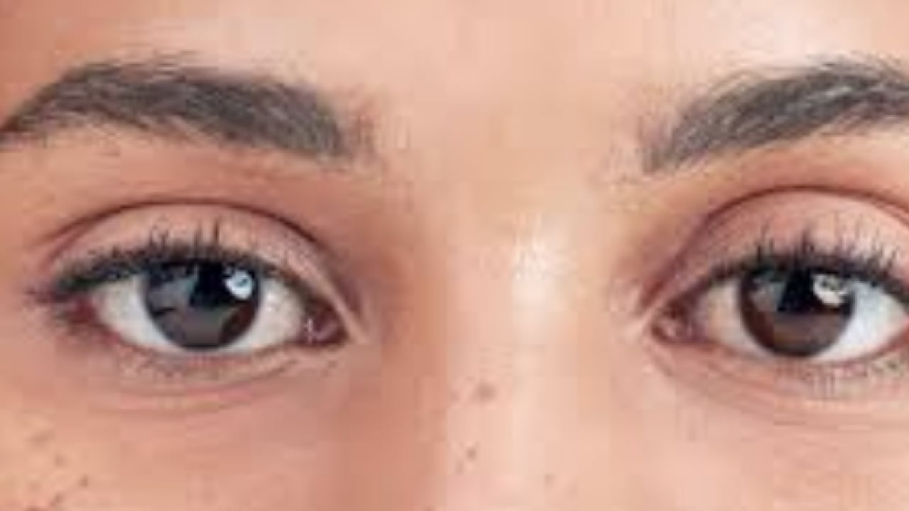 Foto - Op. Dr. açıkladı: Çekici görünen bakışın altında hastalık olabilir