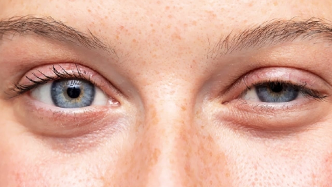 Foto - Op. Dr. açıkladı: Çekici görünen bakışın altında hastalık olabilir