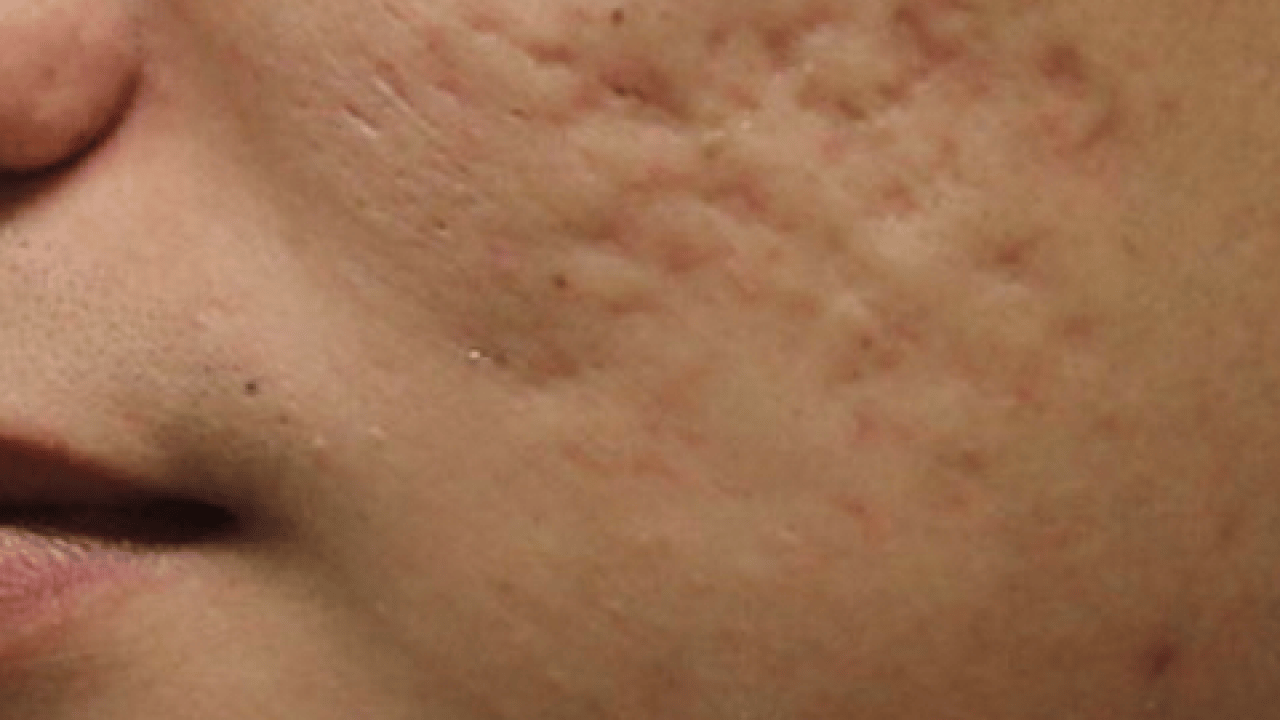 Foto - Özellikle akne tedavilerinde bunu yapmayın! Cildinizi düzelteyim derken psikolojinizden olmayın...