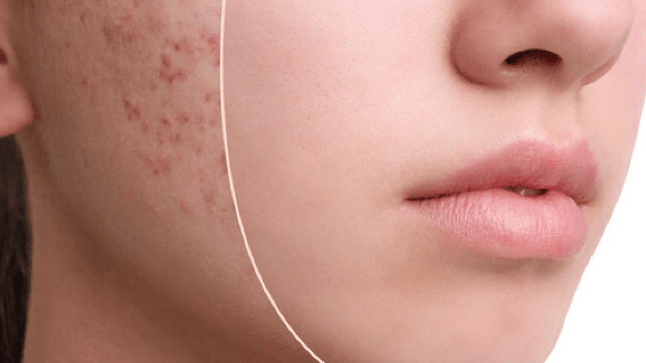 Foto - Özellikle akne tedavilerinde bunu yapmayın! Cildinizi düzelteyim derken psikolojinizden olmayın...