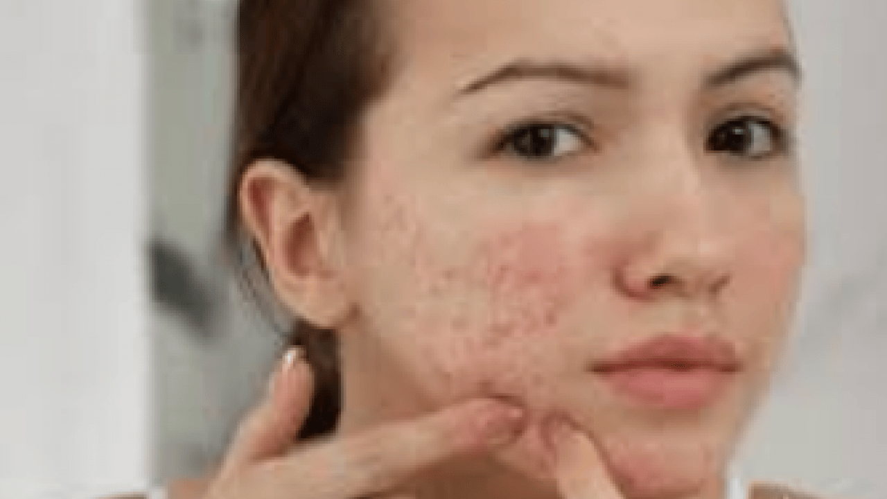 Özellikle akne tedavilerinde bunu yapmayın! Cildinizi düzelteyim derken psikolojinizden olmayın...