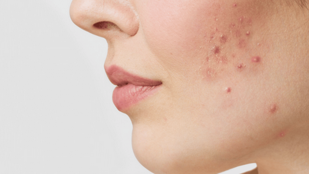 Foto - Özellikle akne tedavilerinde bunu yapmayın! Cildinizi düzelteyim derken psikolojinizden olmayın...