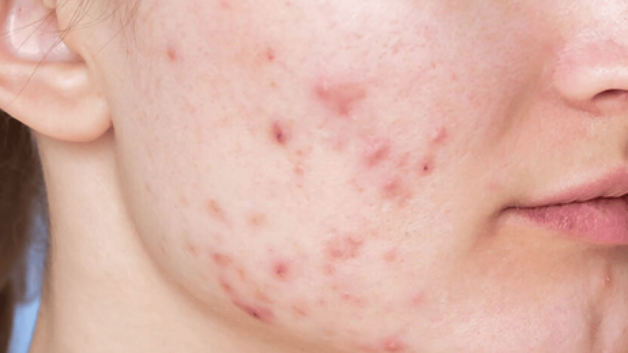 Foto - Özellikle akne tedavilerinde bunu yapmayın! Cildinizi düzelteyim derken psikolojinizden olmayın...