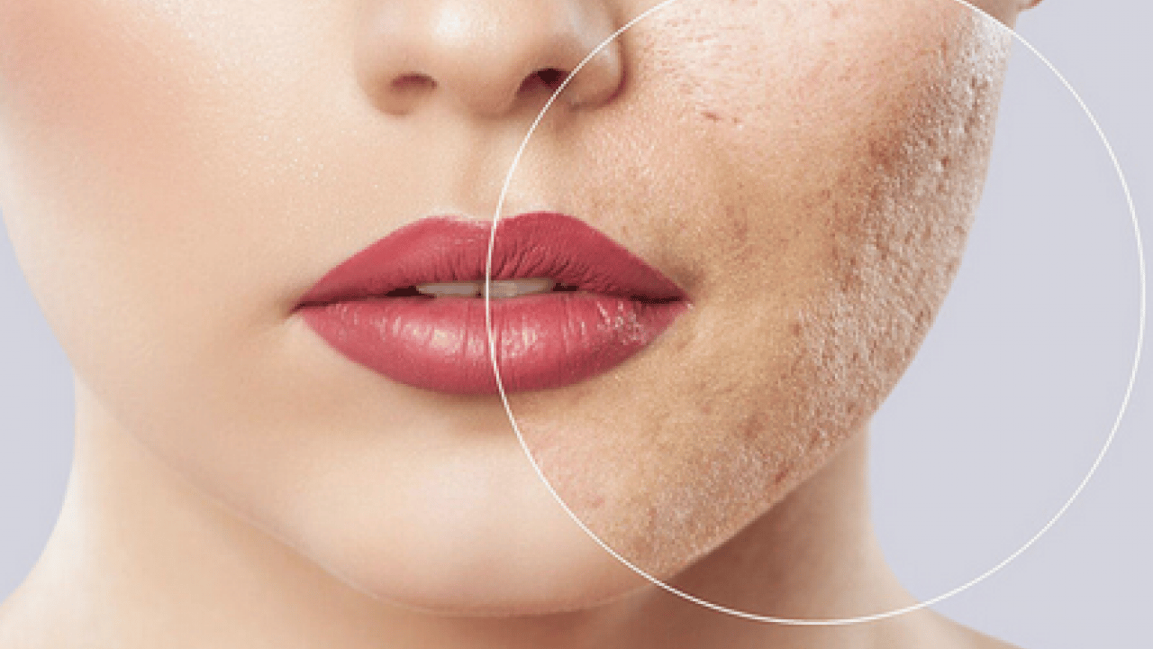 Foto - Özellikle akne tedavilerinde bunu yapmayın! Cildinizi düzelteyim derken psikolojinizden olmayın...