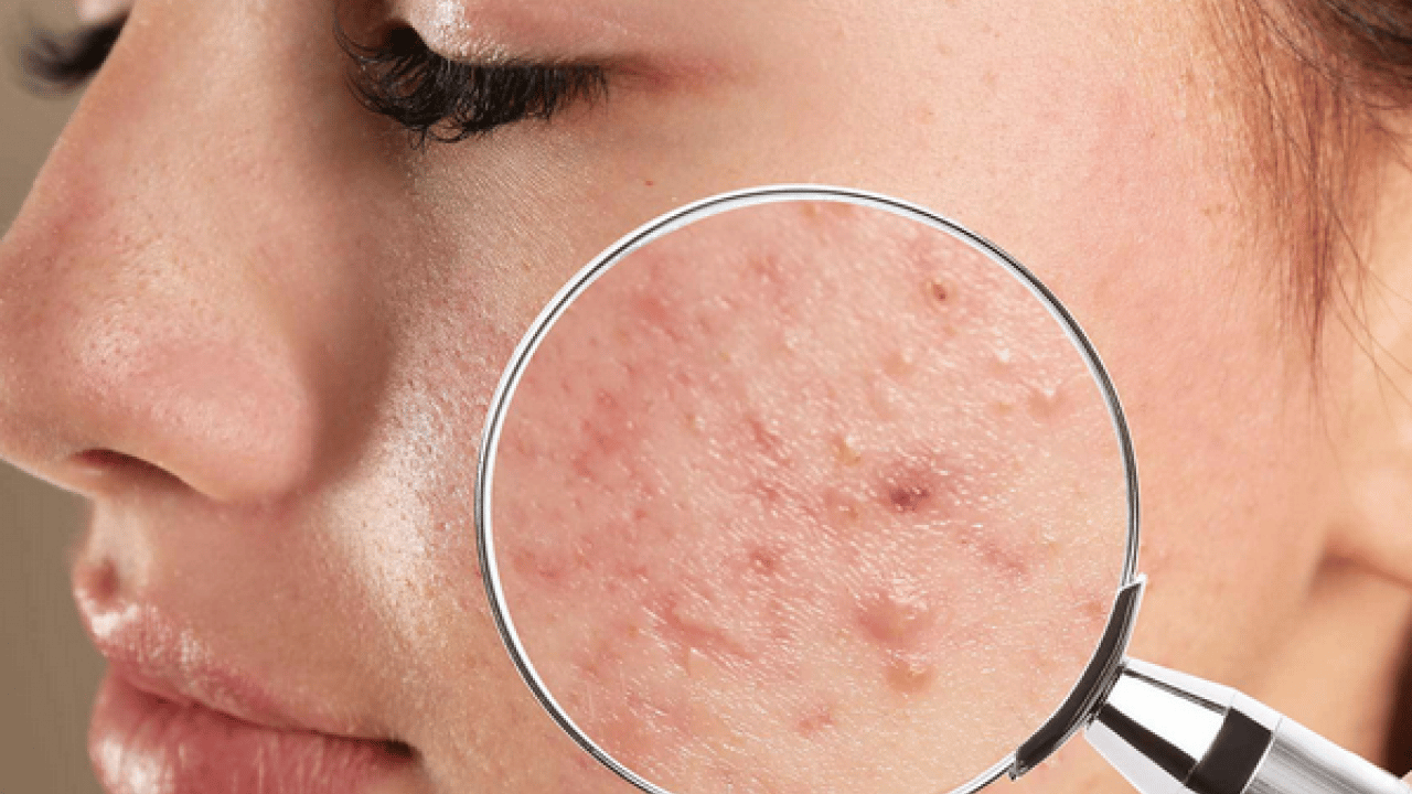 Foto - Özellikle akne tedavilerinde bunu yapmayın! Cildinizi düzelteyim derken psikolojinizden olmayın...