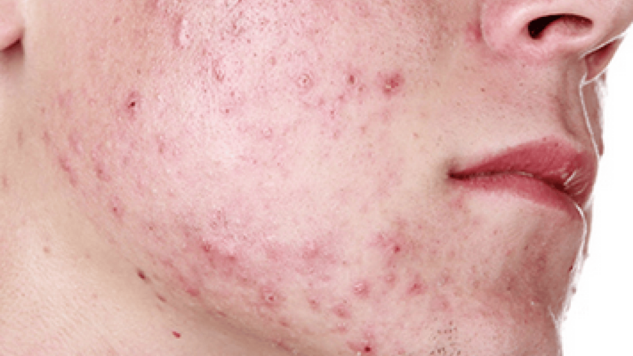 Foto - Özellikle akne tedavilerinde bunu yapmayın! Cildinizi düzelteyim derken psikolojinizden olmayın...