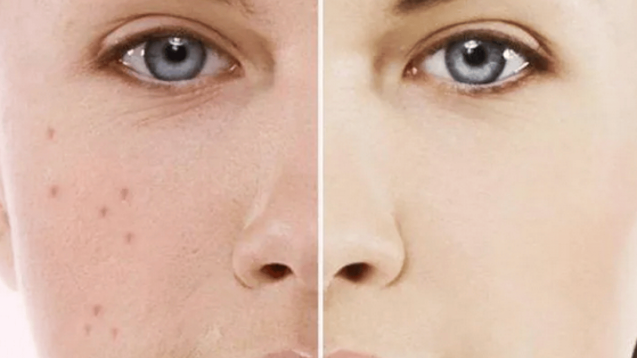 Foto - Özellikle akne tedavilerinde bunu yapmayın! Cildinizi düzelteyim derken psikolojinizden olmayın...