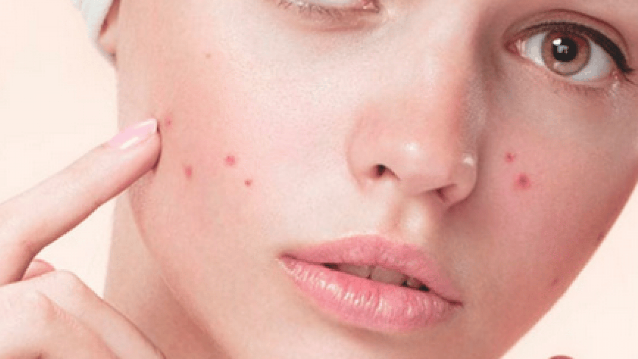 Foto - Özellikle akne tedavilerinde bunu yapmayın! Cildinizi düzelteyim derken psikolojinizden olmayın...