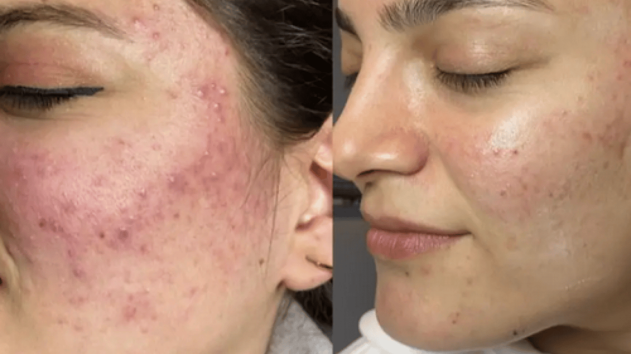 Foto - Özellikle akne tedavilerinde bunu yapmayın! Cildinizi düzelteyim derken psikolojinizden olmayın...