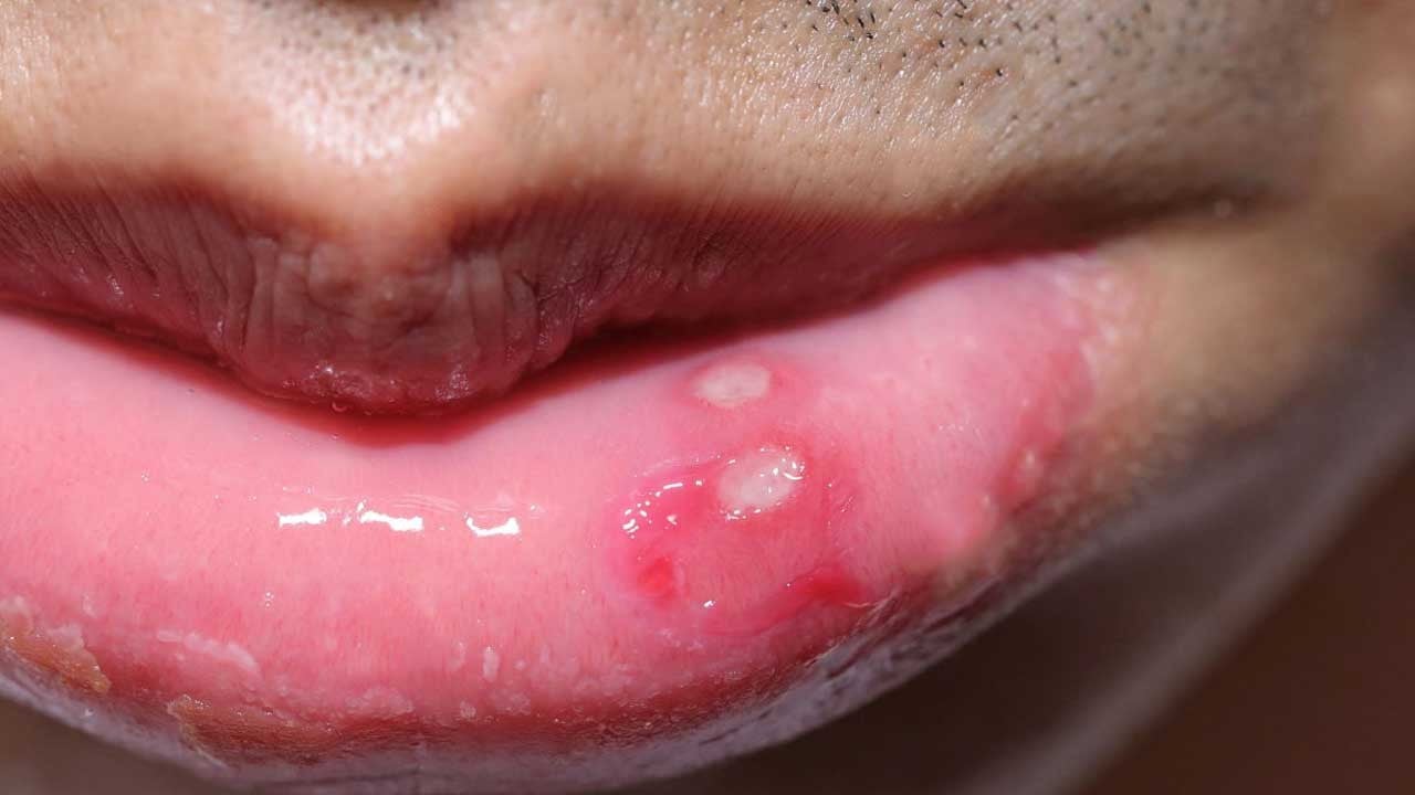 Foto - Padişah baharatı olarak kabul ediliyordu! Sumak: Ağızdaki yaraları 1 saat içinde yok ediyor! 