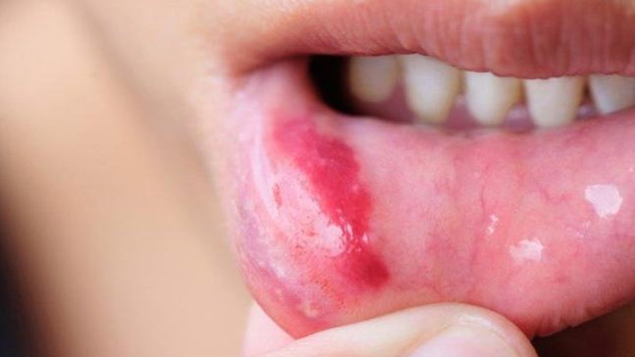 Padişah baharatı olarak kabul ediliyordu! Sumak: Ağızdaki yaraları 1 saat içinde yok ediyor! 