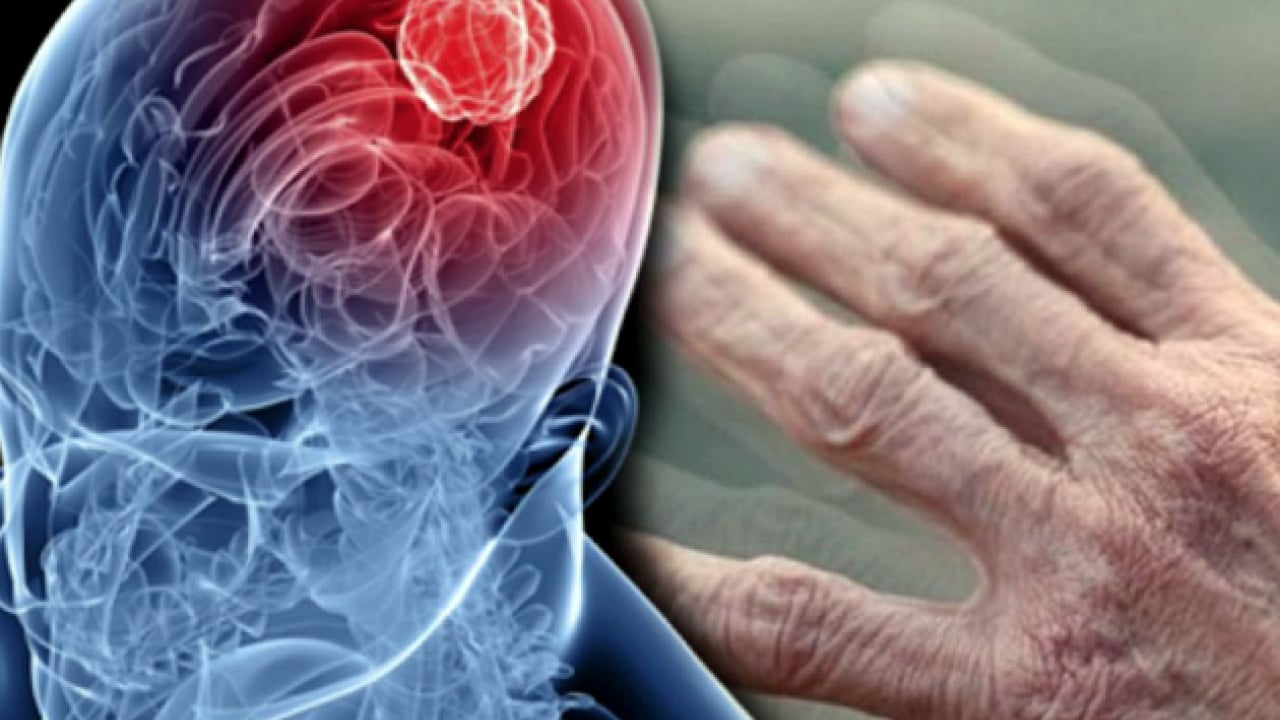 Foto - Parkinson, kök hücre tedavisi: Onlarca yıldır rahatsız olanları ilgilendiriyor! Tersine çevrildi! Sonuç duş etkisi yaptı