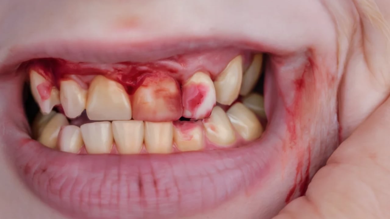 Foto - Periodontal hastalıklar, diyabet ve solunum... Diş eti kanaması sistemik hastalıkların habercisi olabilir