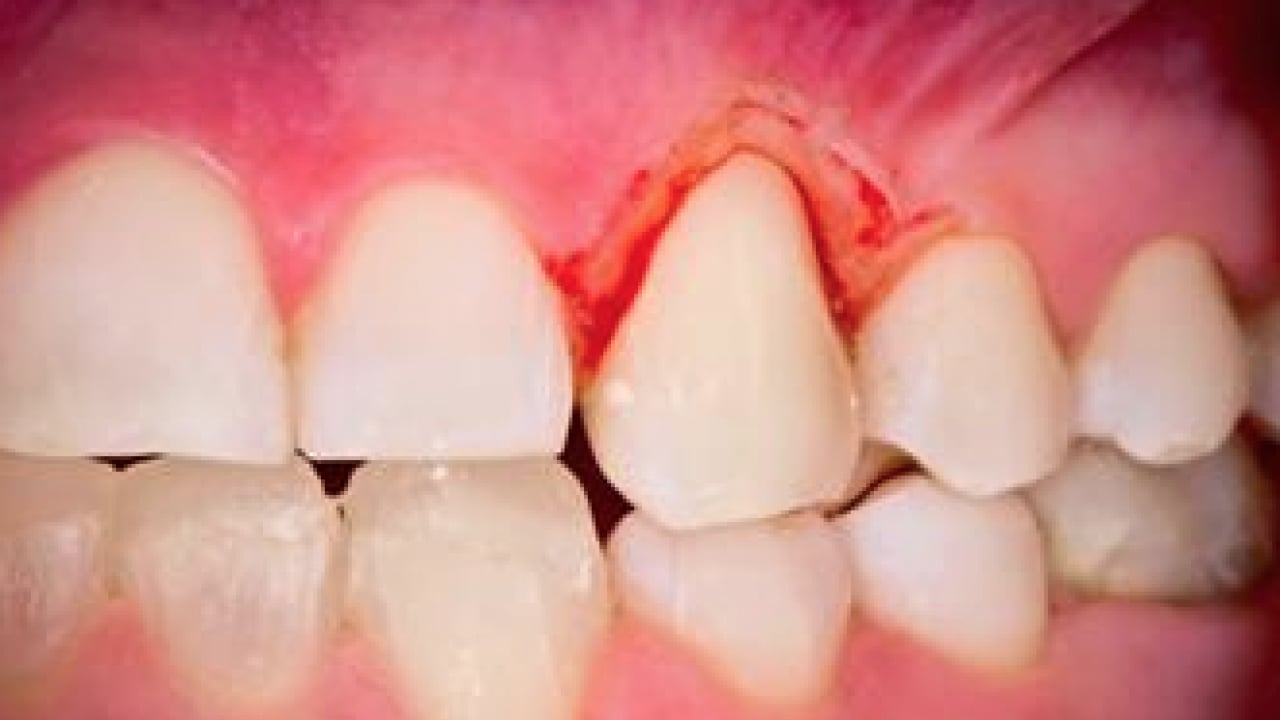 Foto - Periodontal hastalıklar, diyabet ve solunum... Diş eti kanaması sistemik hastalıkların habercisi olabilir
