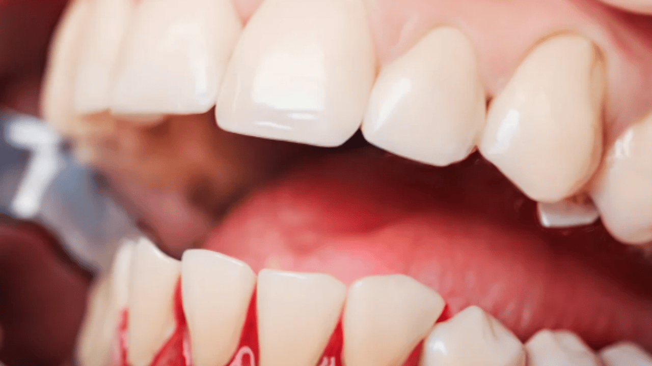 Foto - Periodontal hastalıklar, diyabet ve solunum... Diş eti kanaması sistemik hastalıkların habercisi olabilir