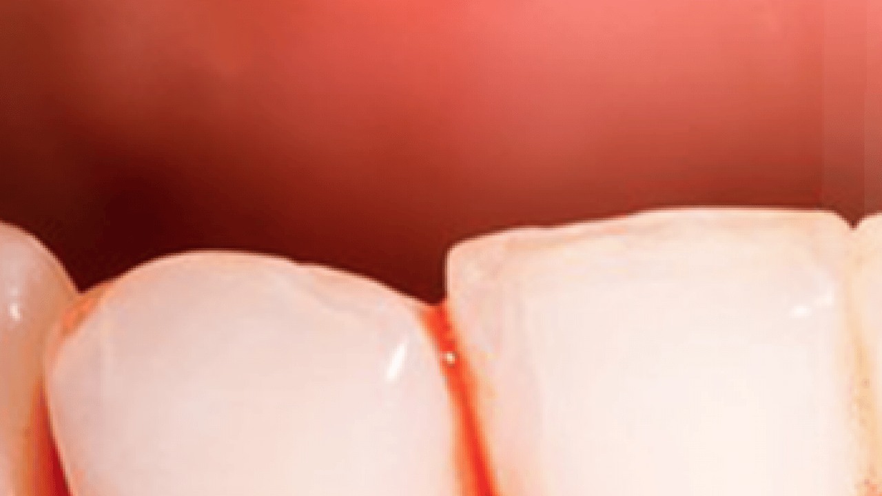 Foto - Periodontal hastalıklar, diyabet ve solunum... Diş eti kanaması sistemik hastalıkların habercisi olabilir