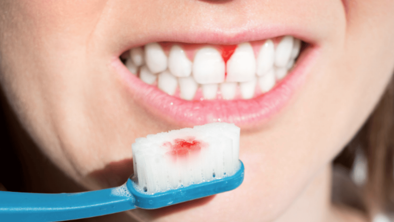 Foto - Periodontal hastalıklar, diyabet ve solunum... Diş eti kanaması sistemik hastalıkların habercisi olabilir