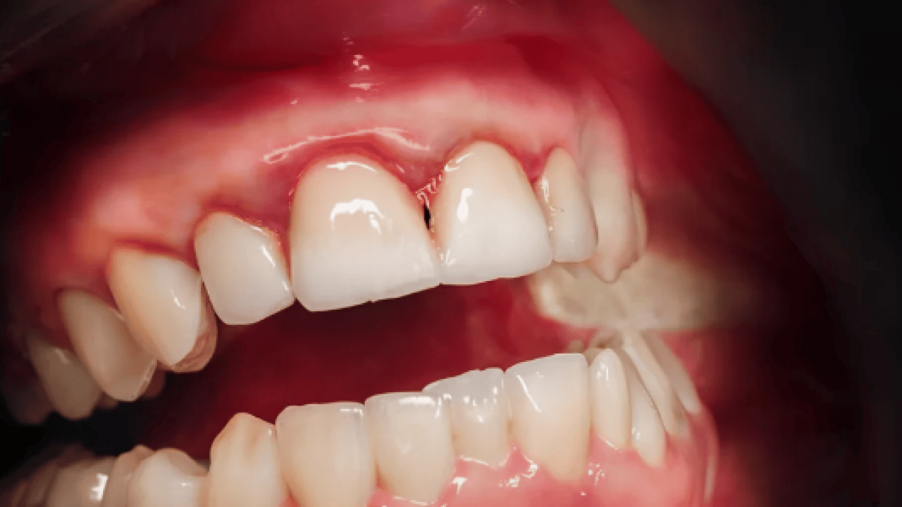 Foto - Periodontal hastalıklar, diyabet ve solunum... Diş eti kanaması sistemik hastalıkların habercisi olabilir