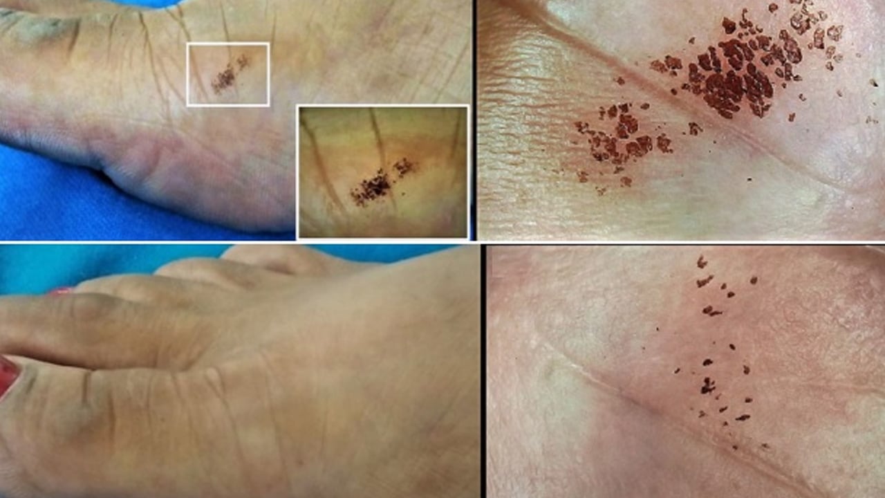 Pire ve böcek lekelerinden bir an önce kurtul: Vücudun her tarafı kabartı, soyulma var diyenler! Bunu yapın olacak