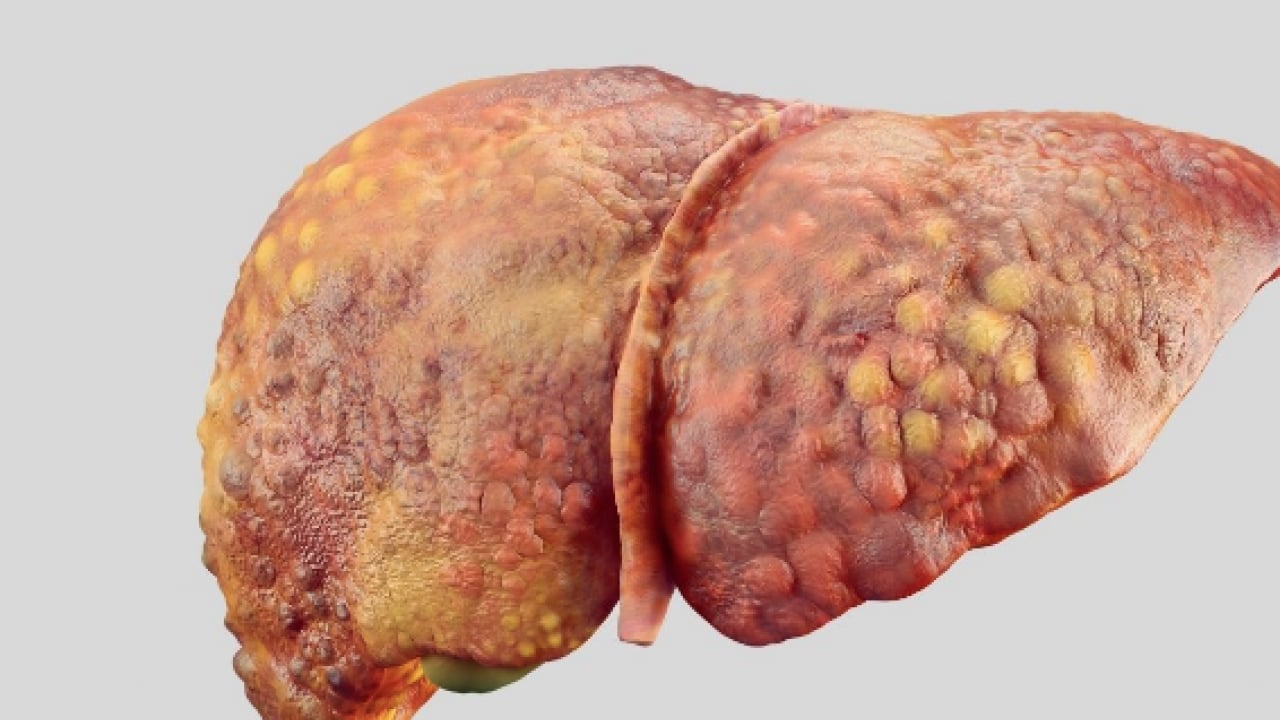 Foto - Pişman olmayın, aman dikkat! Her gün soframızda! Meğer karaciğer yağlanmasını tetikliyormuş