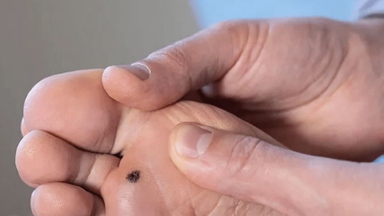 Foto - Prof. Dr. Ahmet Metin, yaz aylarında tatil nedeniyle ortaya çıkıyor diyerek ayak sağlığı uyarısı yaptı