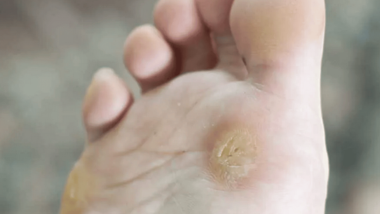 Foto - Prof. Dr. Ahmet Metin, yaz aylarında tatil nedeniyle ortaya çıkıyor diyerek ayak sağlığı uyarısı yaptı