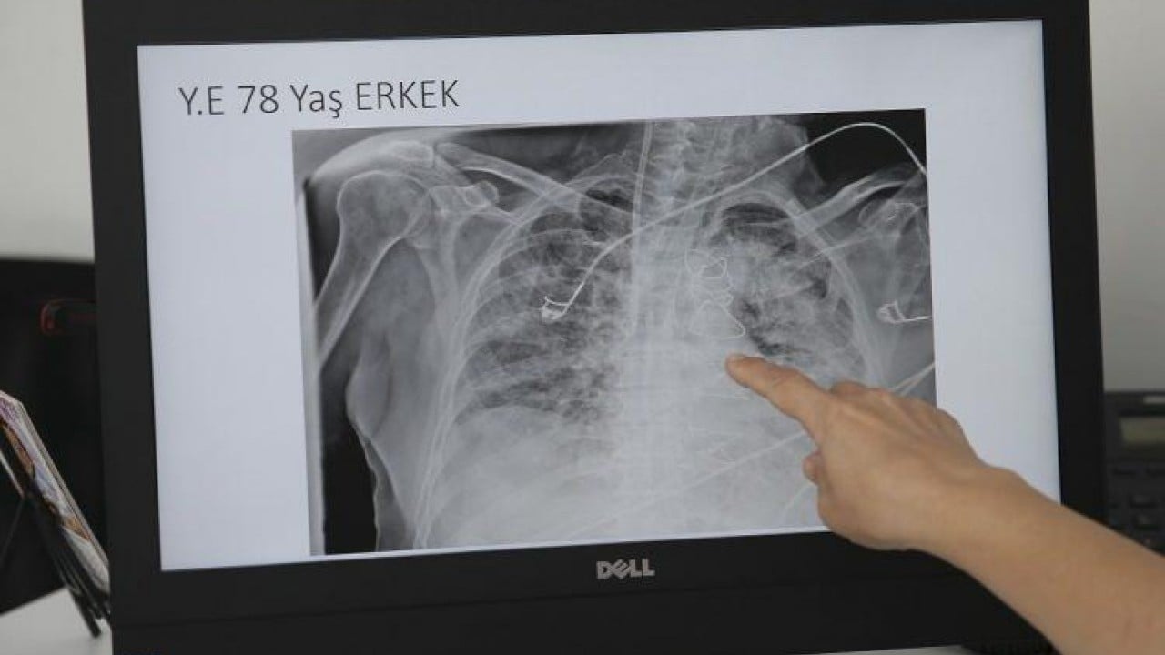 Foto - Prof. Dr. Şener uyardı! Süperenfeksiyona karşı ücretsiz aşınızı olun