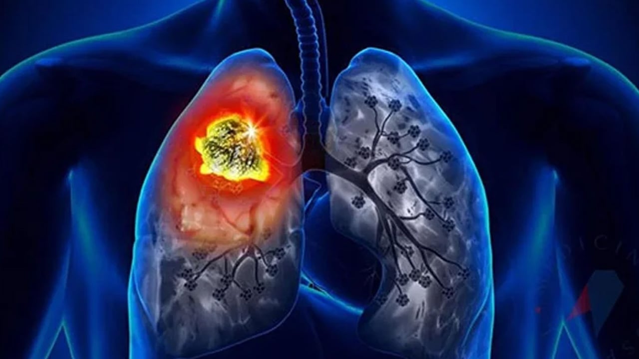 Foto - Prof. Dr. Topgül: Şişkinlik sanılan şey kitle olabilir! Bu işarete dikkat...İşte o belirtisini duyurdu