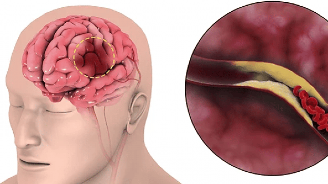 Rehabilitasyona dikkat: İnmede erken tedavi kaybedilen fonksiyonları geri getiriyor...