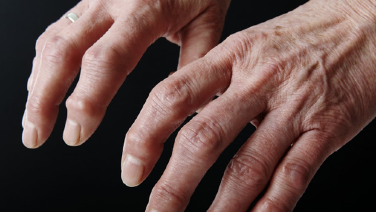 Foto - Romatoloji uzmanı anlattı: Romatizmal hastalıklarda yaşam tarzı değişikliği yaşam kalitesini artırıyor