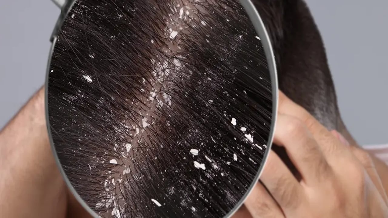 Saç diplerindeki kepeği bıçak gibi kesiyor! Sadece birkaç damlası bile biiznillah çare oluyor