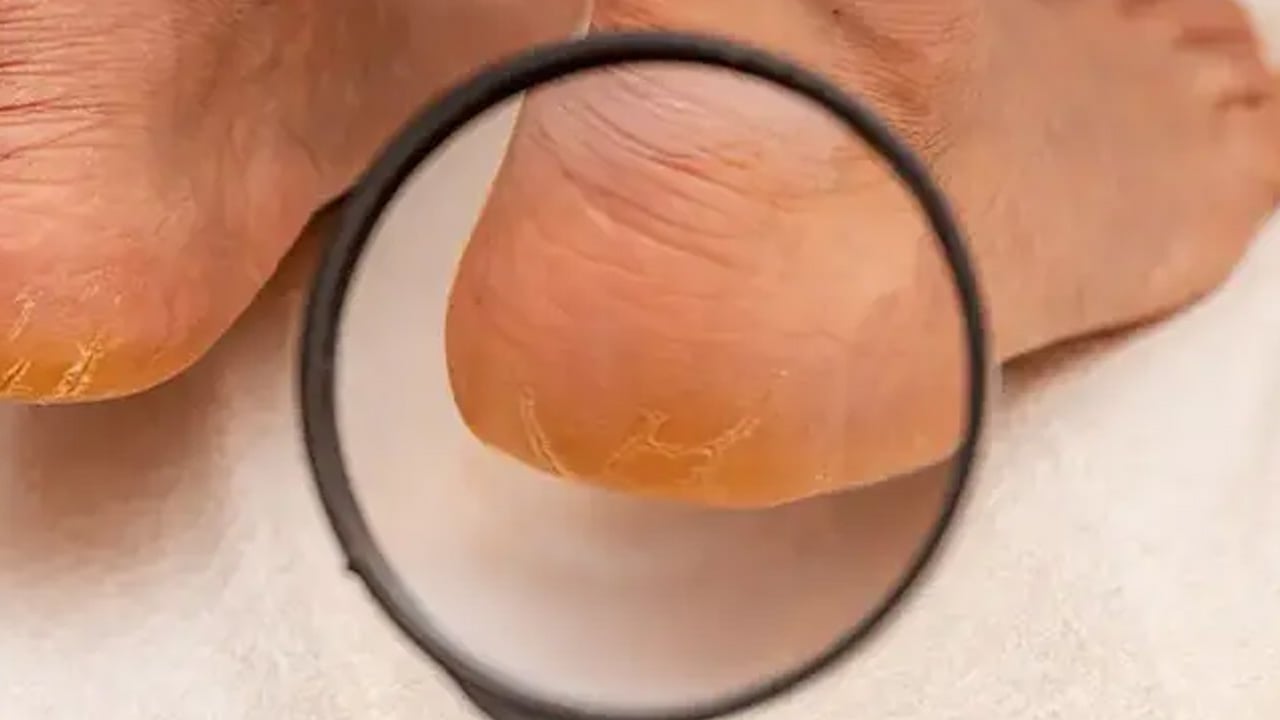 Foto - Saç dökülmesi için çare olur, bu şekilde uygulayın! Elma sirkesi sertleşmiş nasırı kağıt gibi soyuyor! Püf noktası...