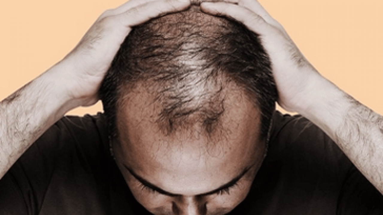 Foto - Saç dökülmesi olanlar dikkat! Tutam tutam saçları dökülenler bu konuyu düşünmeli...