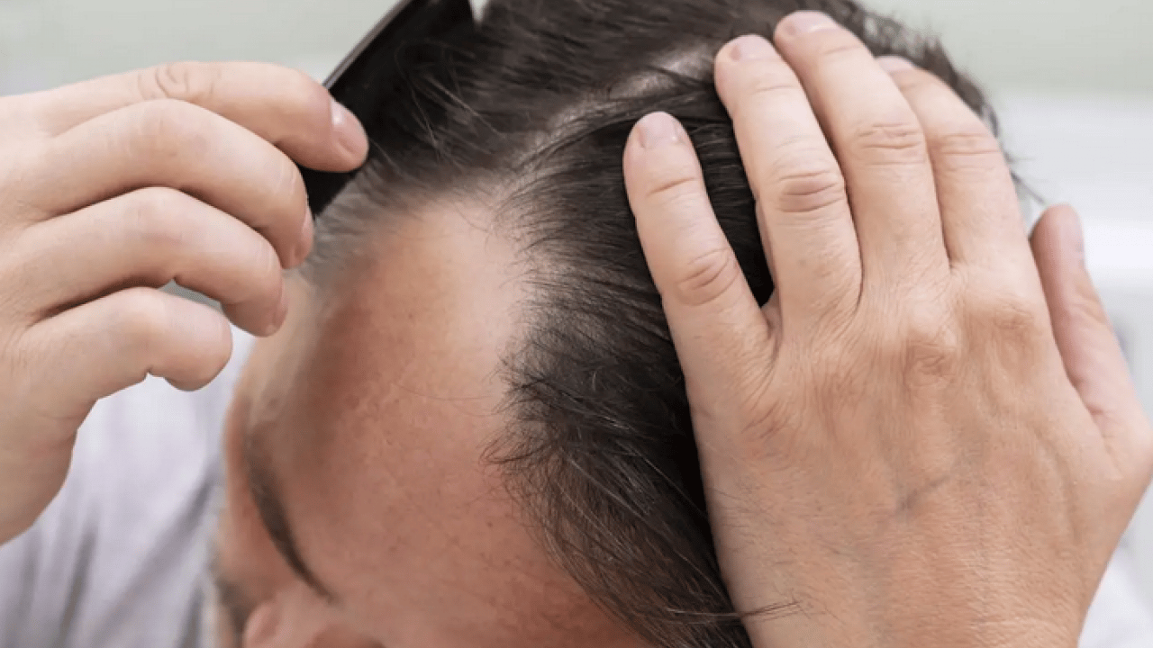 Foto - Saç dökülmesi olanlar dikkat! Tutam tutam saçları dökülenler bu konuyu düşünmeli...