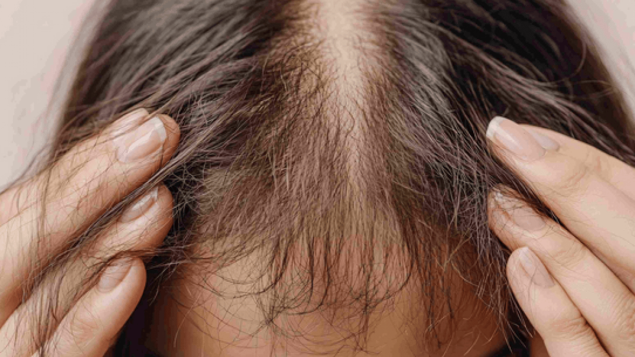 Foto - Saç dökülmesi olanlar dikkat! Tutam tutam saçları dökülenler bu konuyu düşünmeli...