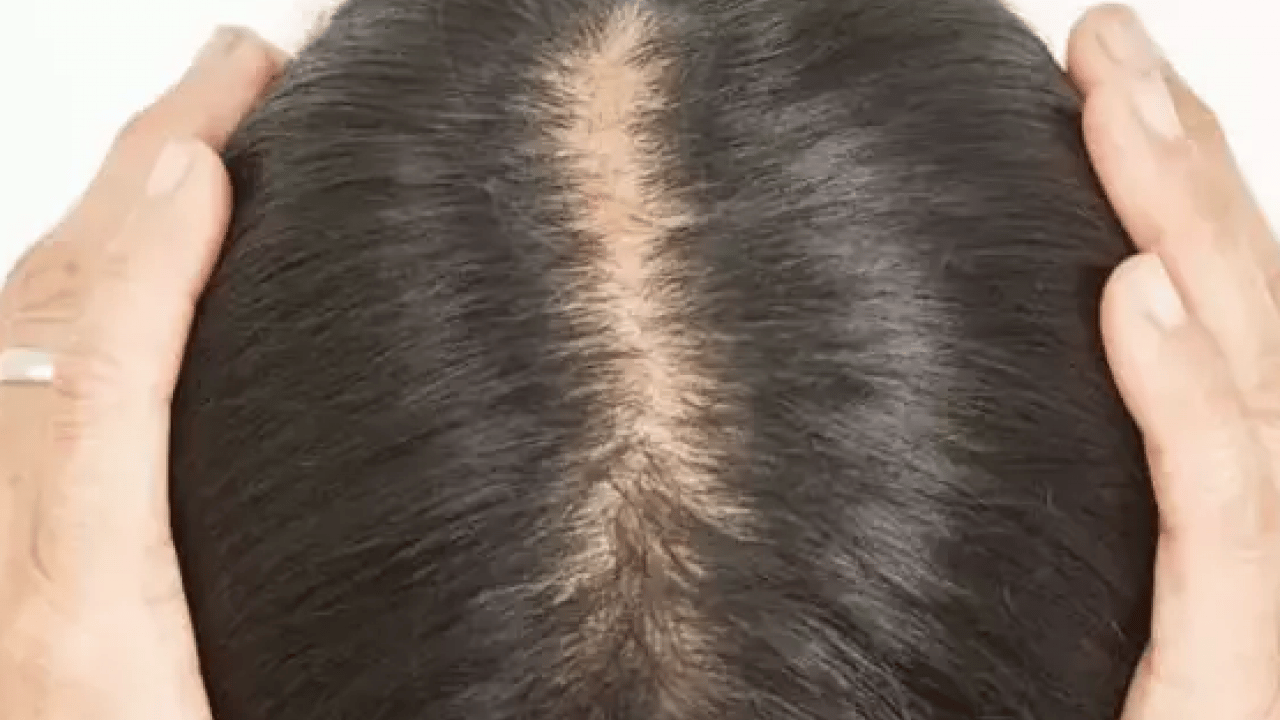 Saç dökülmesi olanlar dikkat! Tutam tutam saçları dökülenler bu konuyu düşünmeli...