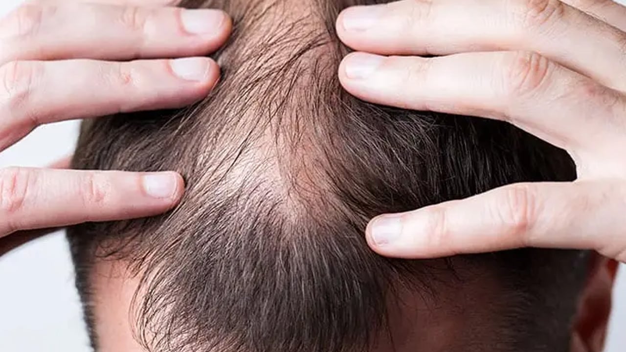 Foto - Saç dökülmesinde doğru bilinen yanlış: Zararlı maddeleri sessiz sedasız içine çekiyor