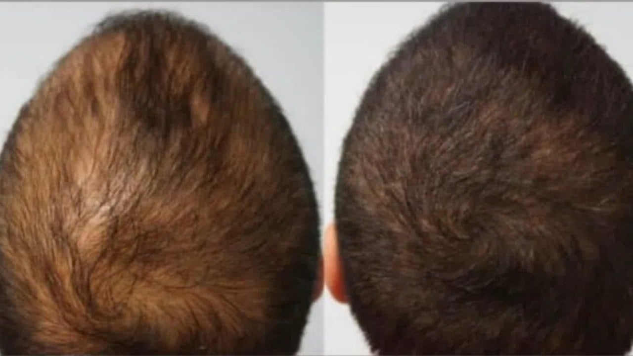 Foto - Saç dökülmesini 20 günde durduran serum üretildi!