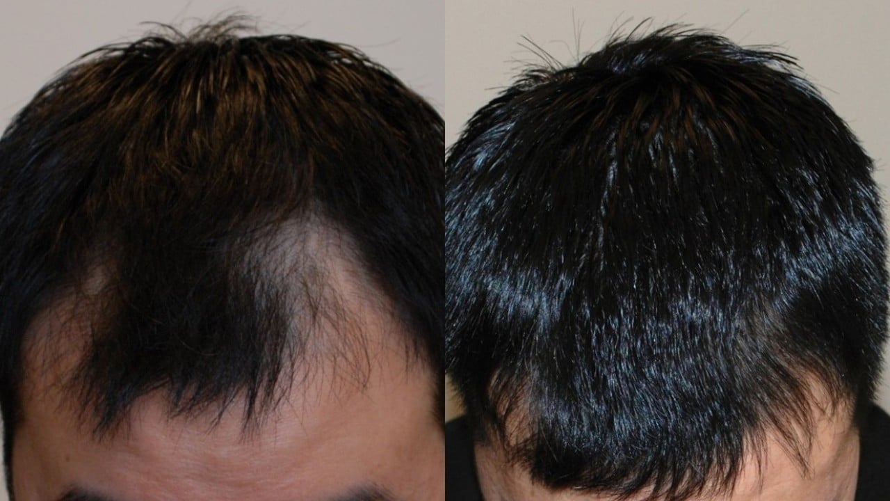 Foto - Saç dökülmesini 20 günde durduran serum üretildi!