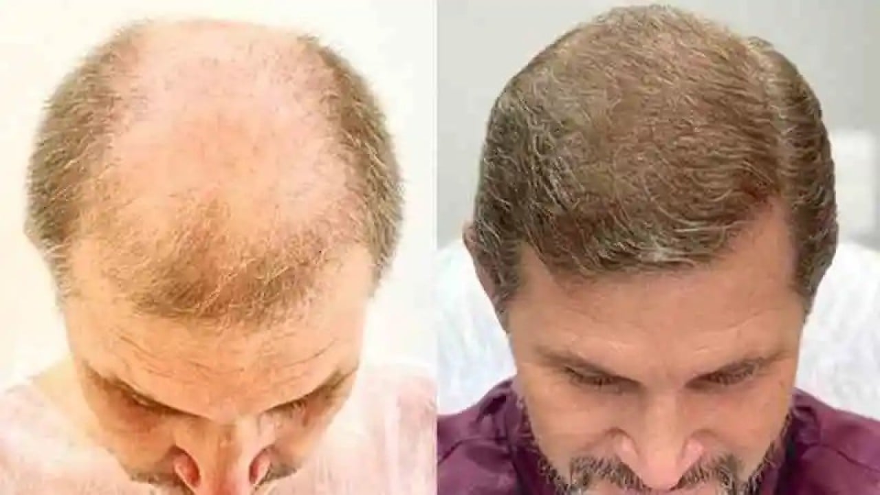 Saç dökülmesini 20 günde durduran serum üretildi!