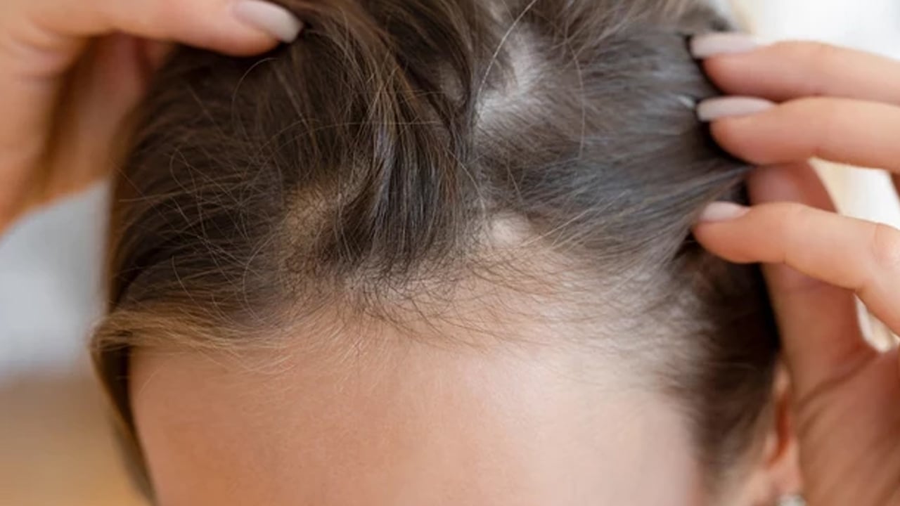 Foto - Saç dökülmesini hızlıca kesiyor: Bu yiyecek saç dökülmesini anında durduruyor! Büyük bir etkiye sahip olduğu biliniyor!